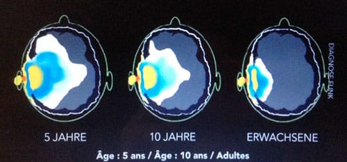 Pénétration des ondes hautes fréquences dans le cerveau à différents ages